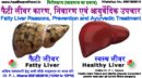 फैटी लीवर कारण, निवारण एवं आयुर्वेदिक उपचार-Fatty Liver Reasons, Prevention and Ayurvedic Treatment