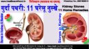 गुर्दा पथरी: 11 घरेलू नुस्खे-Kidney Stones: 11 Home Remedies