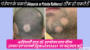 गंजेपन के चकत्ते (Alopecia or Patchy Baldness) ठीक हो सकते हैं